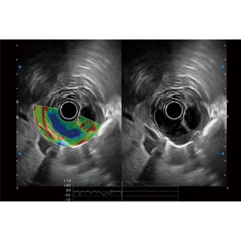 Sonoscape Eg Uc5 Endoscopic Ultrasound